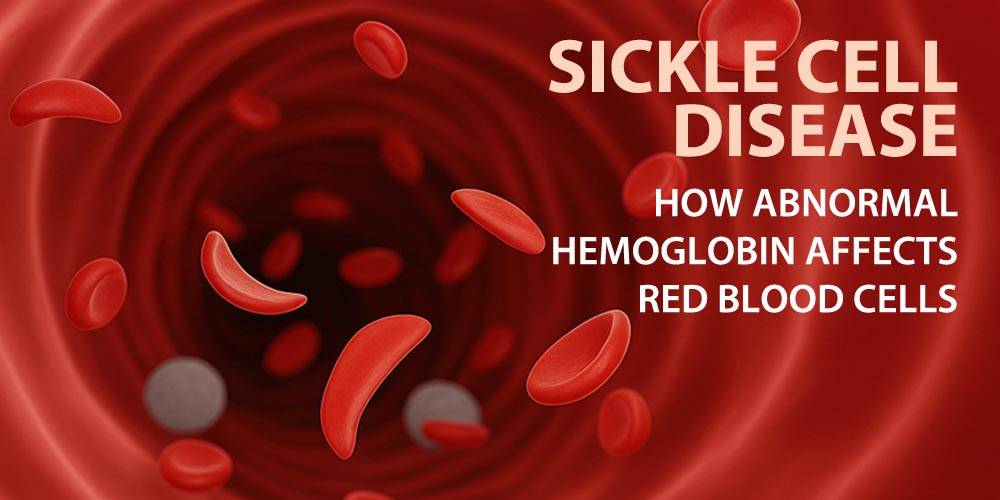 Comprehensive Guide to Sickle Cell Anemia: Causes, Symptoms, Treatments, and Effective Management Strategies